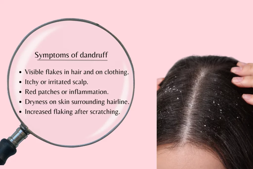 Symptoms of dandruff